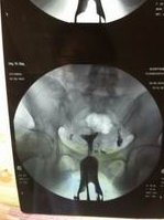 伊犁州妇幼保健院试管婴儿多少钱？专家可信赖